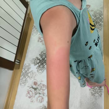 Nivea Sun Güneş Kremi Koruma Sağlamadı Ve Aile Yanık Yaşadı