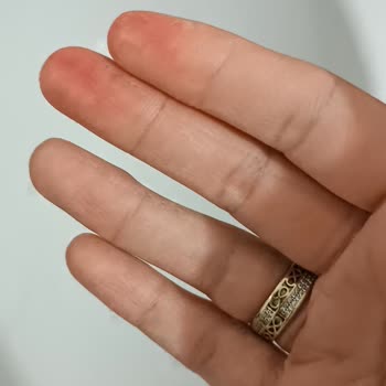 Duracell Pillerinin Aşırı Isınması Çocuğumun Yanmasına Neden Oldu