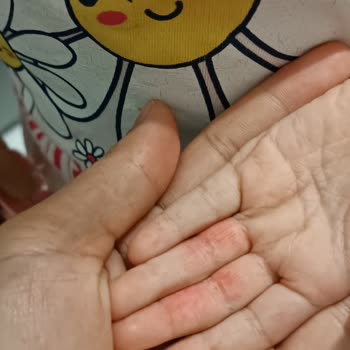 Duracell Pillerinin Aşırı Isınması Çocuğumun Yanmasına Neden Oldu