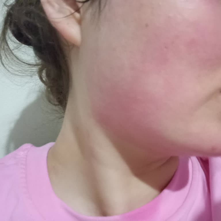 Yves Rocher Yüz Yıkama Jelinde Şiddetli Yanma Ve Kızarıklık