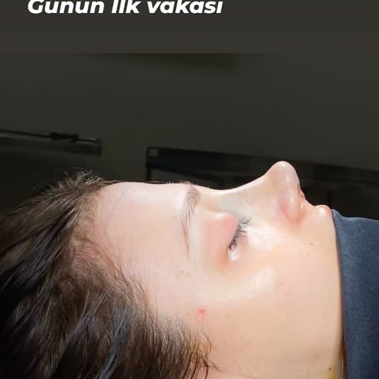 Rinoplasti Sonucu Uzun Ve Asimetrik Burun, Doktor Hatası Şüphesi