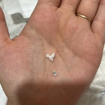 Bebek Bezinde Sert Beyaz Yabancı Parçalar Bulunması Ve Güvenlik Endişesi
