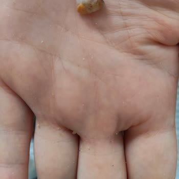 Çıtır Leblebi İçinde Taş Benzeri Yabancı Madde
