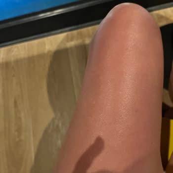 Bronzlaştırıcı Yağda Kızarıklık Ve Sağlık Riski