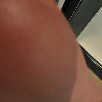 Bronzlaştırıcı Yağda Kızarıklık Ve Sağlık Riski