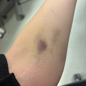 Kan Alımında Şişlik Ve Morarma: Personelin Yetersiz Desteği