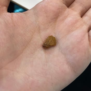 Granola İçindeki Badem Kabuğu Diş Tedavisi Geçiren Müşteriye Ağrı Ve Sağlık Tehlikesi Oluşturdu