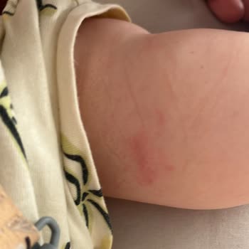 Bebek Kan Alımında Aşırı Sıkıştıran Turnike Kullanımı