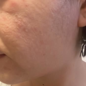 Yves Rocher Ürünleri Nedeniyle Cilt Reaksiyonu Ve Müşteri Hizmetleri İlgisizliği