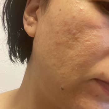 Yves Rocher Ürünleri Nedeniyle Cilt Reaksiyonu Ve Müşteri Hizmetleri İlgisizliği