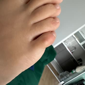 İnce Alt Taban Ve Ayak Sağlığını Tehlikeye Atan Babette İade Reddi