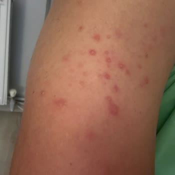 Veet Men Tüy Dökücü Kremi Kullanım Sonrası Şiddetli Kızarıklık Ve Şişlik