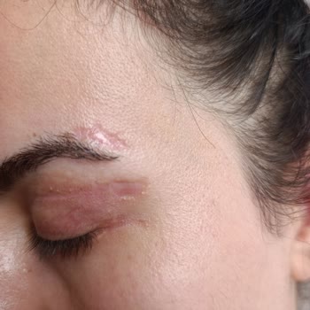 Estegöz Klinik'te Göz Kapak Ameliyatı Sonrası İz, Asimetri Ve Sinir Bozukluğu
