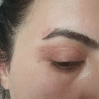 Estegöz Klinik'te Göz Kapak Ameliyatı Sonrası İz, Asimetri Ve Sinir Bozukluğu