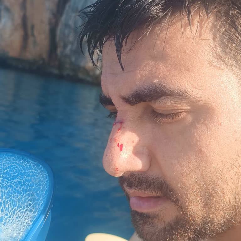 Decathlon Yüzme Gözlüğünün Patlaması Sonrası Yaralanma Ve Tazmin Talebi