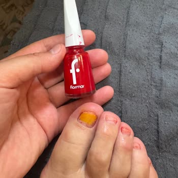Flormar Kırmızı Ojesi Nedeniyle Alerjik Kaşıntı Ve Tırnak Deformasyonu