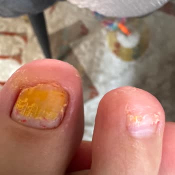 Flormar Kırmızı Ojesi Nedeniyle Alerjik Kaşıntı Ve Tırnak Deformasyonu