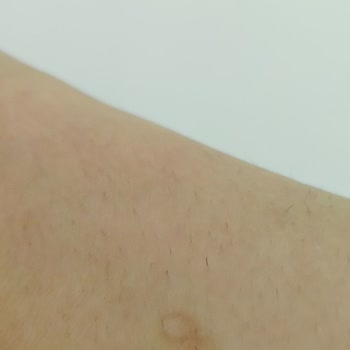 Erzurum Real Life VIP Güzellik Merkezinde Lazer Epilasyon Sonucu Yanık Ve Saç Artışı