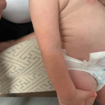 Dalin Care Atocure Bebekte Şiddetli Kızarıklık Ve Döküntü Yaratıyor