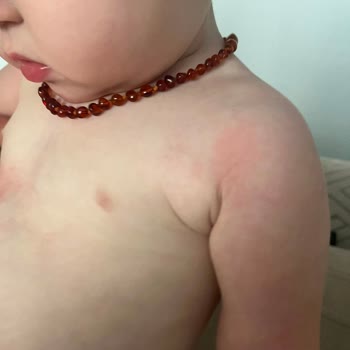 Dalin Care Atocure Bebekte Şiddetli Kızarıklık Ve Döküntü Yaratıyor