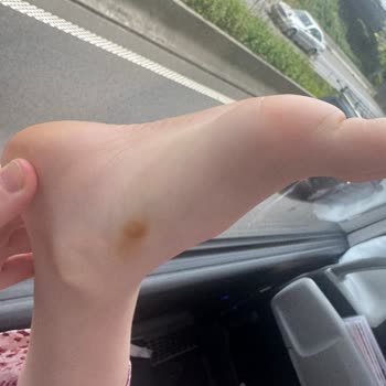 Paslanan Zımba Kısmı Çocuğumun Ayağında İz Bıraktı Ve Üretim Hatası İade Reddi