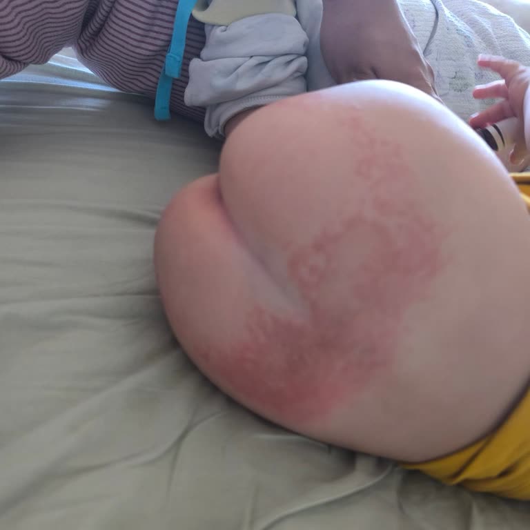 Minies Bebek Bezi Şiddetli Pişik Ve Cilt Tahrişi Yarattı