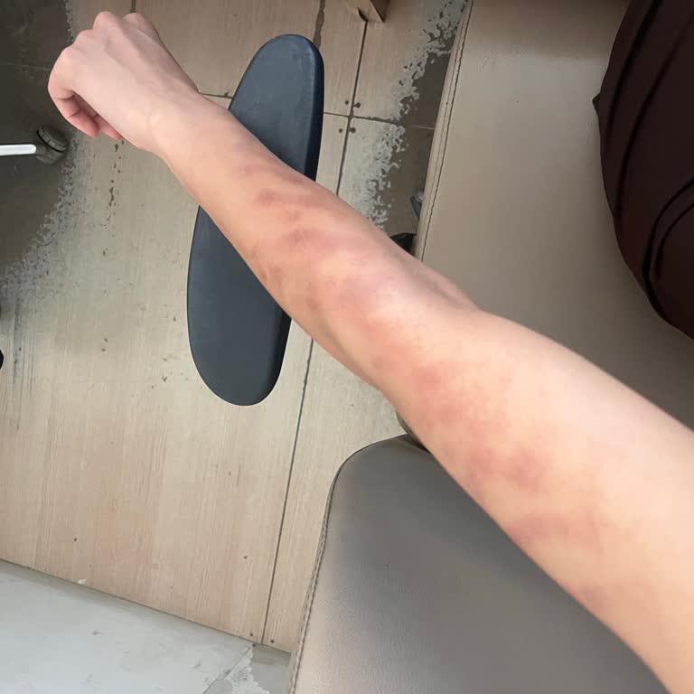 Real Life Güzellik Merkezinde Lazer Epilasyon Sonrası Ciddi Yanık Ve Yetersiz İlgi