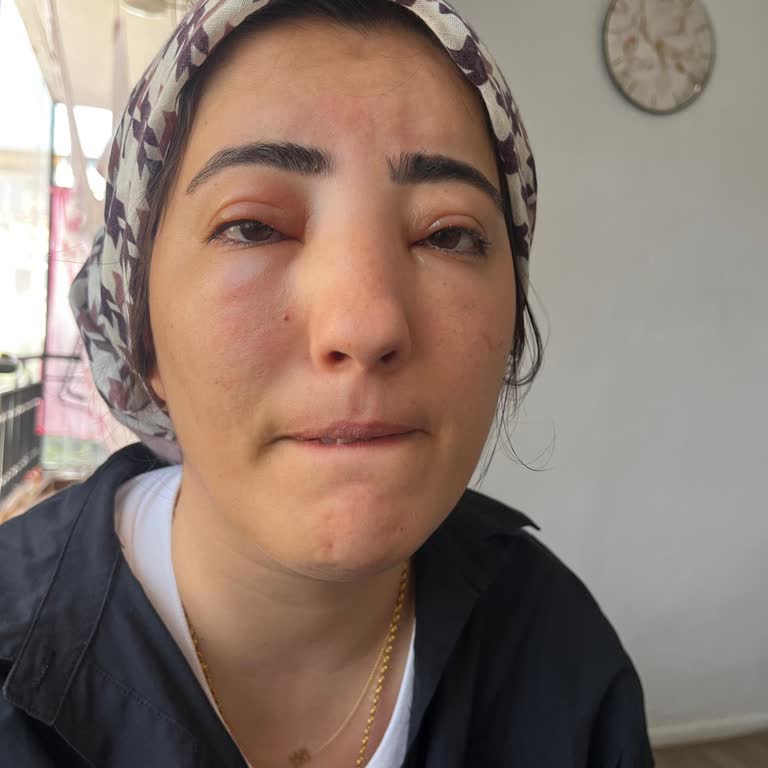 Hijyenik Olmayan Makyaj Ve Türban Sonucu Kardeşimin Sağlığına Ağır Zarar Ve Ücret İadesi Talebi
