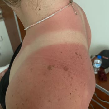Avene Çocuk Güneş Kremi Kullanımından İkinci Derece Yanıklar Ve Şiddetli Ağrı