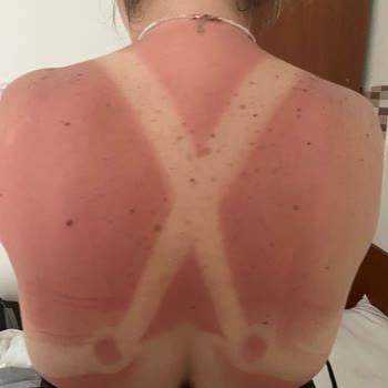 Avene Çocuk Güneş Kremi Kullanımından İkinci Derece Yanıklar Ve Şiddetli Ağrı