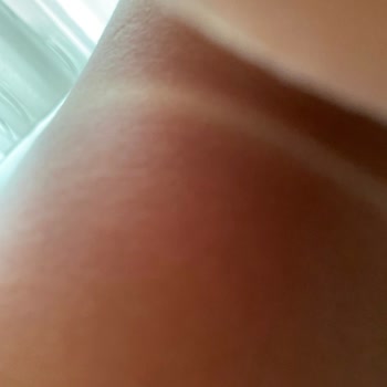 Avene Çocuk Güneş Kremi Kullanımından İkinci Derece Yanıklar Ve Şiddetli Ağrı