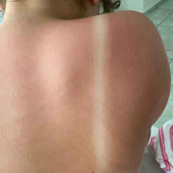 Avene Çocuk Güneş Kremi Kullanımından İkinci Derece Yanıklar Ve Şiddetli Ağrı