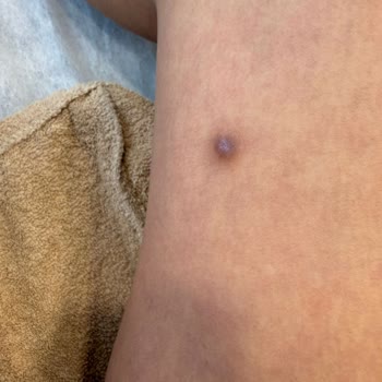 Estetik Dikiş Sonrası Lazer Tedavisi İz Renginin Koyulaşması Ve İyileşme Olmaması