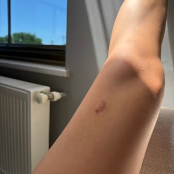 Estetik Dikiş Sonrası Lazer Tedavisi İz Renginin Koyulaşması Ve İyileşme Olmaması