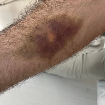 Serum Uygulaması Sonrası Kol Morarması Ve Ağrı İçin Tedavi Ve İade Talebi