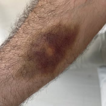 Serum Uygulaması Sonrası Kol Morarması Ve Ağrı İçin Tedavi Ve İade Talebi