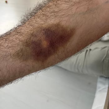 Serum Uygulaması Sonrası Kol Morarması Ve Ağrı İçin Tedavi Ve İade Talebi
