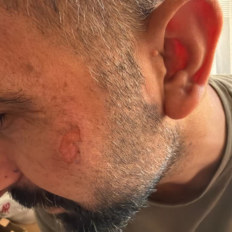 Batman Golden Güzellik Merkezi’nde Lazer Epilasyon Sonrası İkinci Derece Yanık Ve Ciddi Mağduriyet