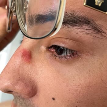 Versace Gözlüğünün Ciltte Oluşturduğu Ağır Tahriş Nedeniyle İade Talebi