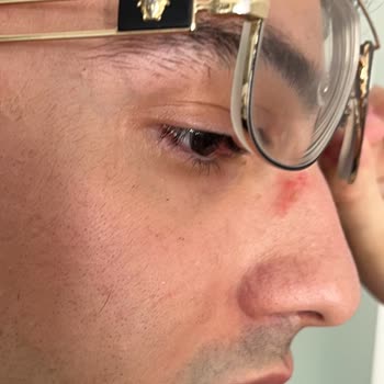 Versace Gözlüğünün Ciltte Oluşturduğu Ağır Tahriş Nedeniyle İade Talebi