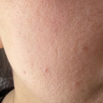 Bioderma Sébium Sensitive Deneme Boyu Ciltte Şiddetli Kaşıntı Ve Pütürlenme Yarattı