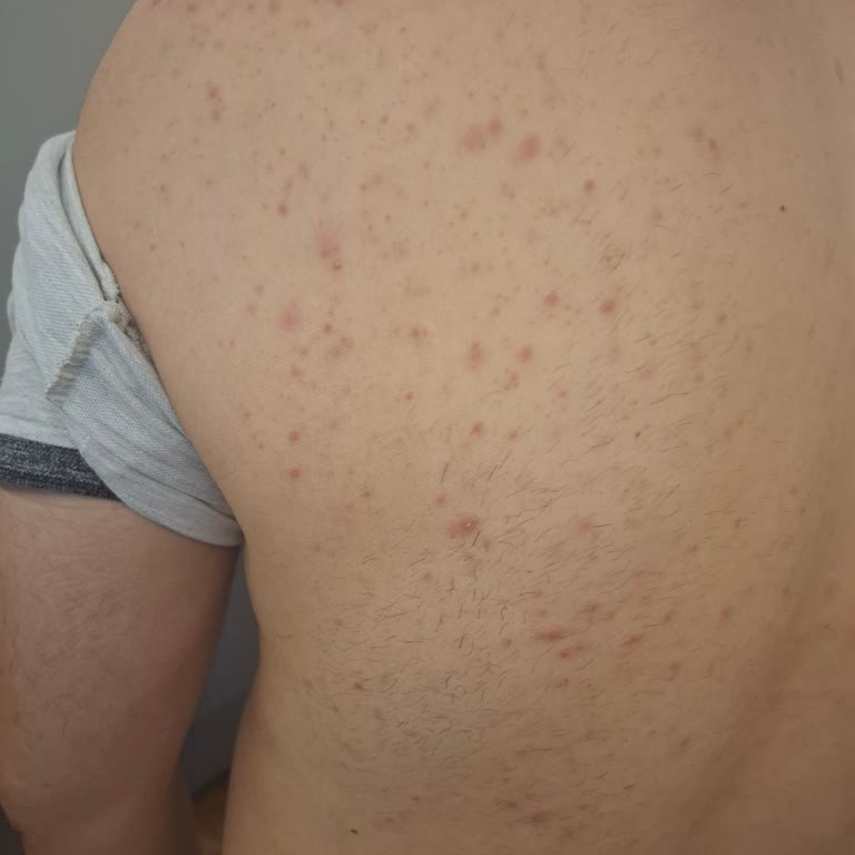 Alerjik Reaksiyon Ve Şiddetli Sivilceler Nedeniyle Veet Kremi Şikayeti