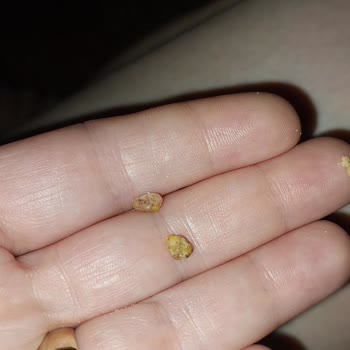 Eti Puf Karışık Ürününde Sert Cisimler Çıktı Ve Çocuk Sağlığı Tehlikeye Girdi