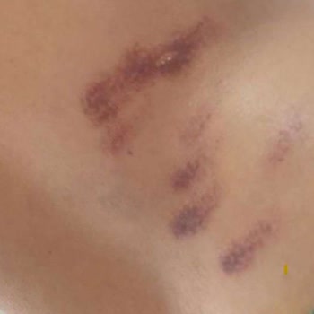Lazer Yanığı Ve İade Reddi: 460 Bin TL Zarara Karşı Şikayet