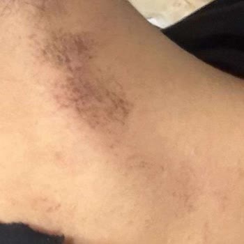Lazer Yanığı Ve İade Reddi: 460 Bin TL Zarara Karşı Şikayet