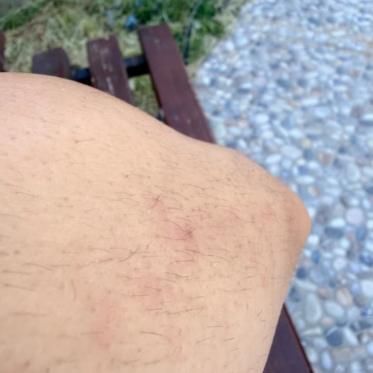 30 Bin TL'lik Lazer Epilasyon Sonrası Aşırı Kıllanma Ve Yanıltıcı Garanti