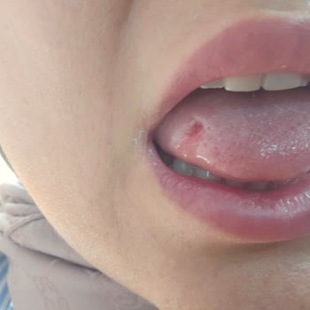 Dil Yarası Yaratan Diş Hekiminin Dikkatsiz Ve Cevapsız Tutumu