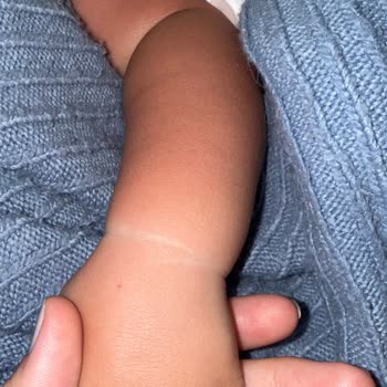 Güneş Spreyi Çocuğumda Yanık Bıraktı