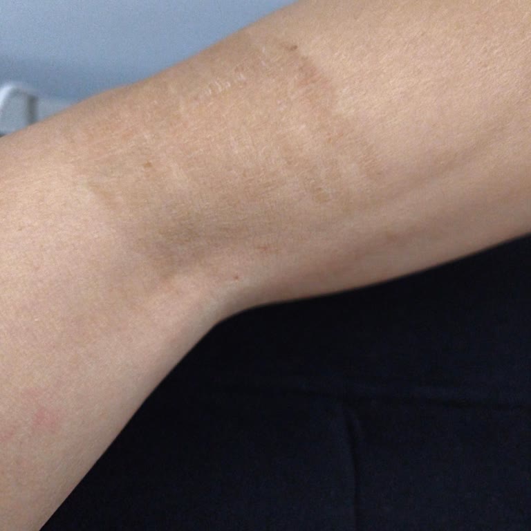 Hemşirelerin Yetersizliği Ve Alerjik Reaksiyon Nedeniyle Yaşanan Sorun
