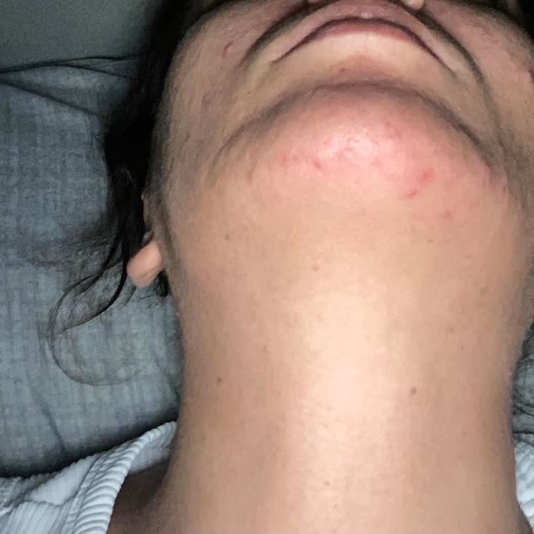 PH Lab Retinal Ürünü Kullanımında Şiddetli Alerjik Reaksiyon Ve İade Talebi